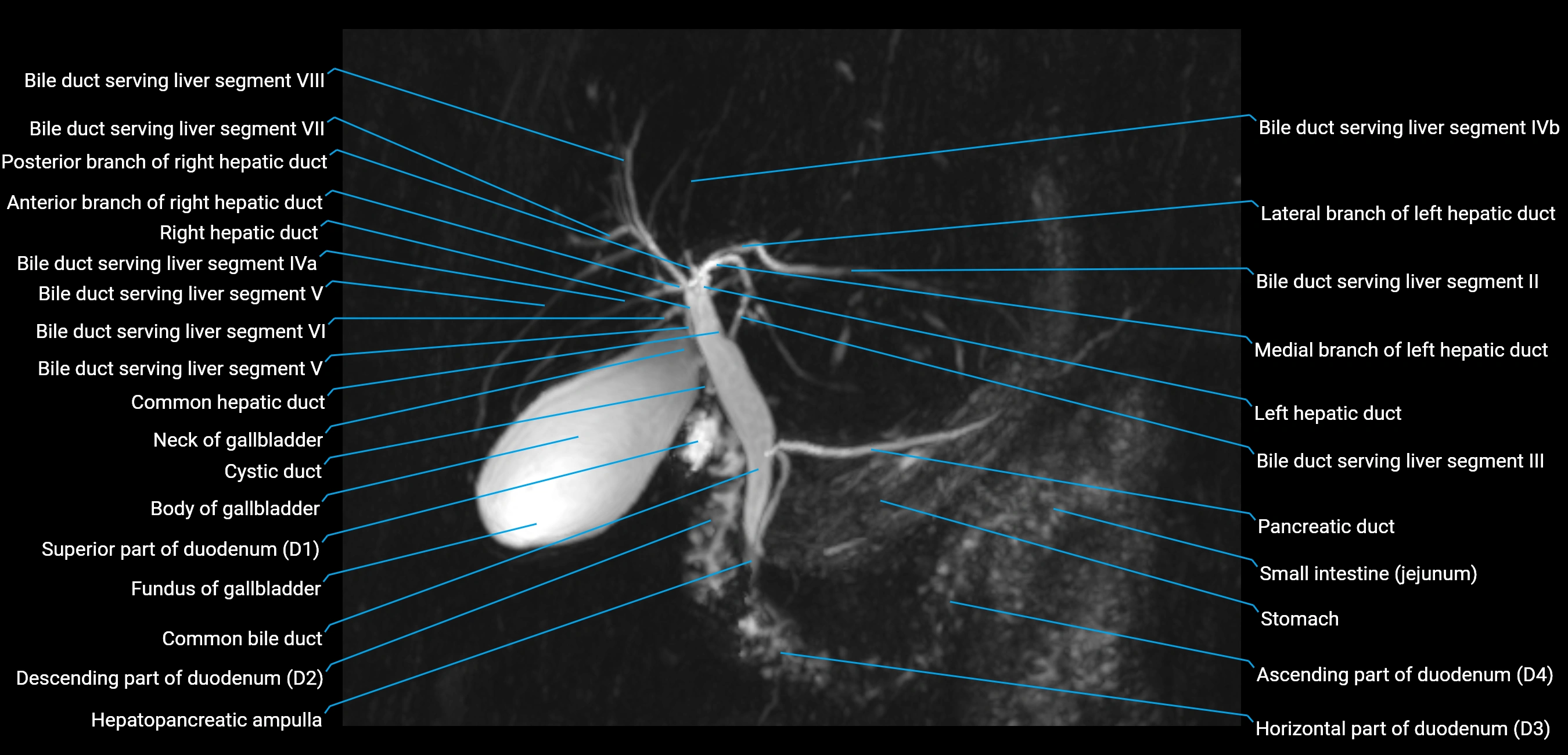MRCP MIP MRI  anatomy labelled image-img-01003-00010.webp